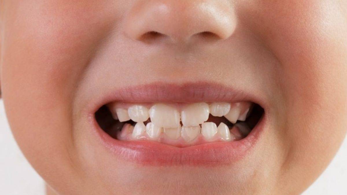 Большие передние зубы у детей