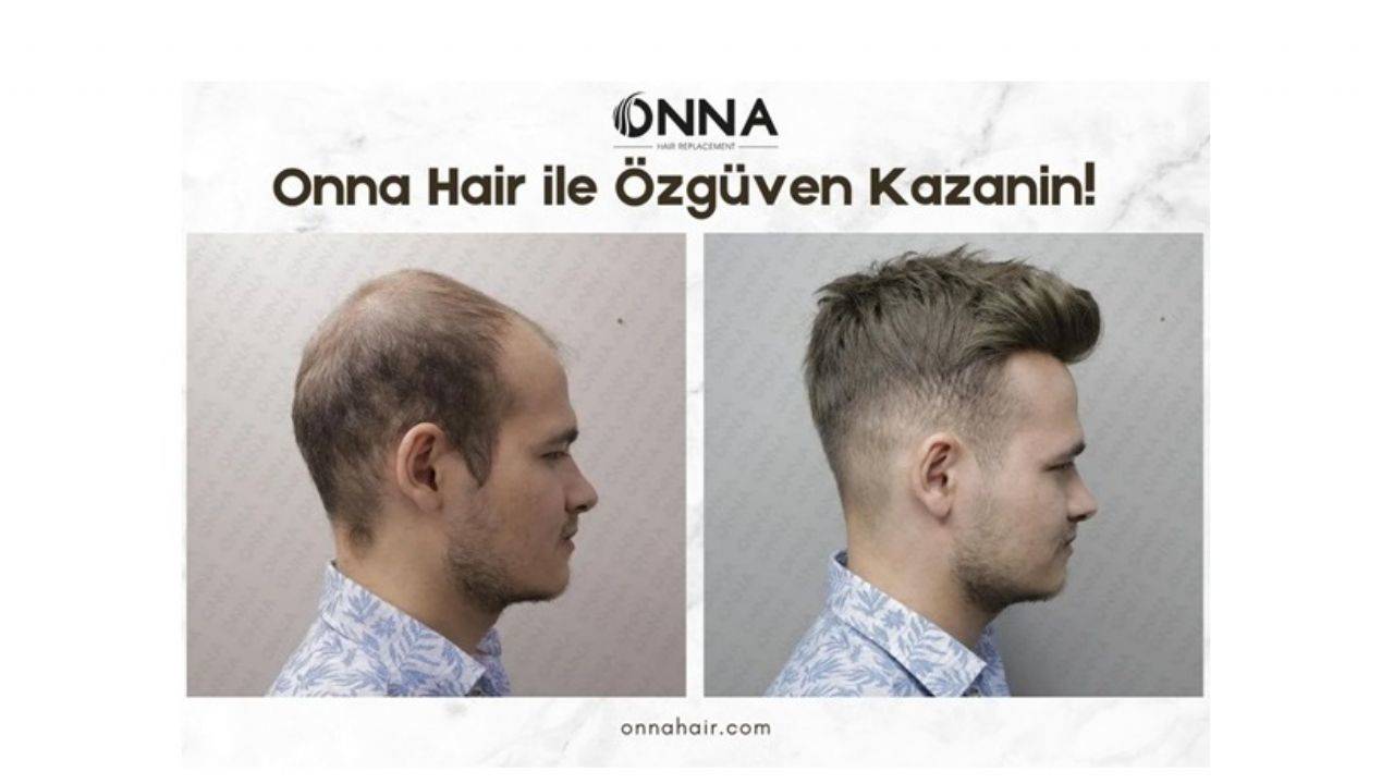 Onna Hair Protez Saç ile Özgüven Kazanın!